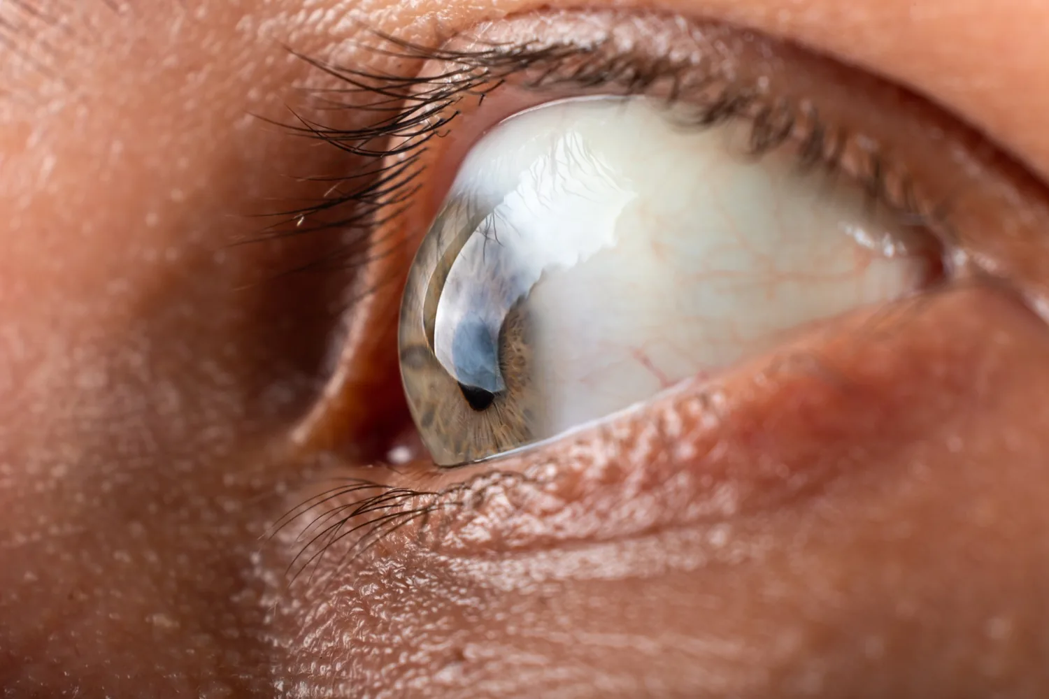 Keratoconus